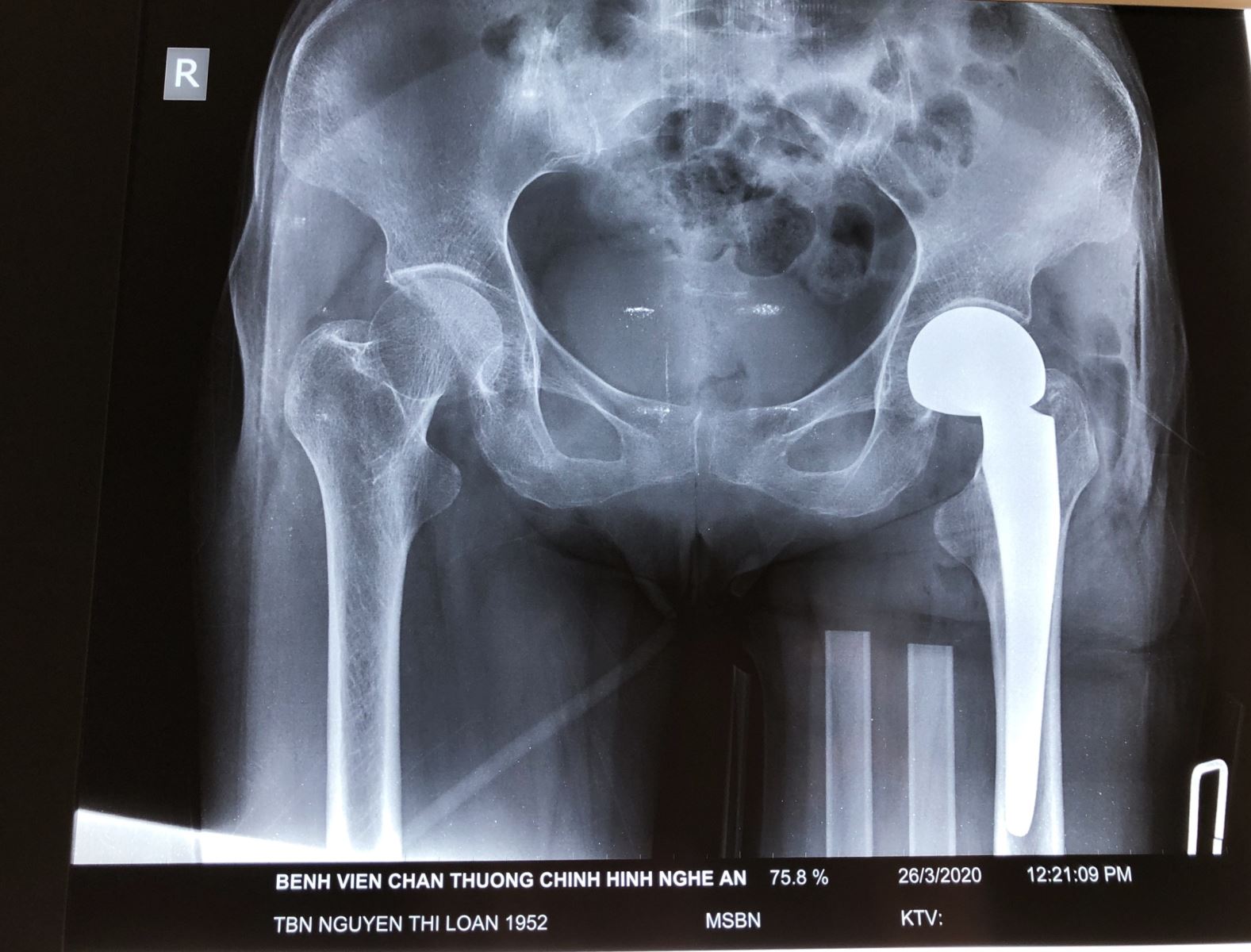 Hình ảnh phim chụp Xquang của bệnh nhân trước và sau phẫu thuật thay khớp háng